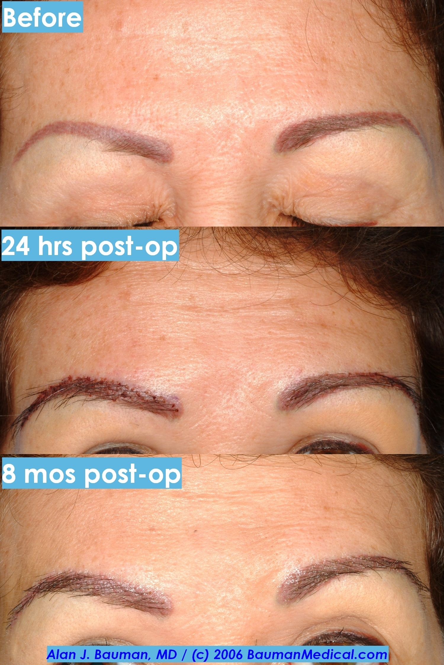 Eyebrow Transplantation Special Cases Bauman Medical Group