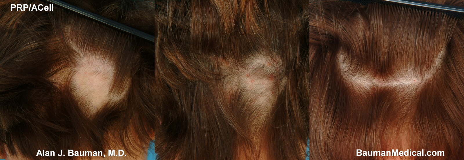 Female Alopecia Areata Patient Treated With Prp For Hair Regrowth