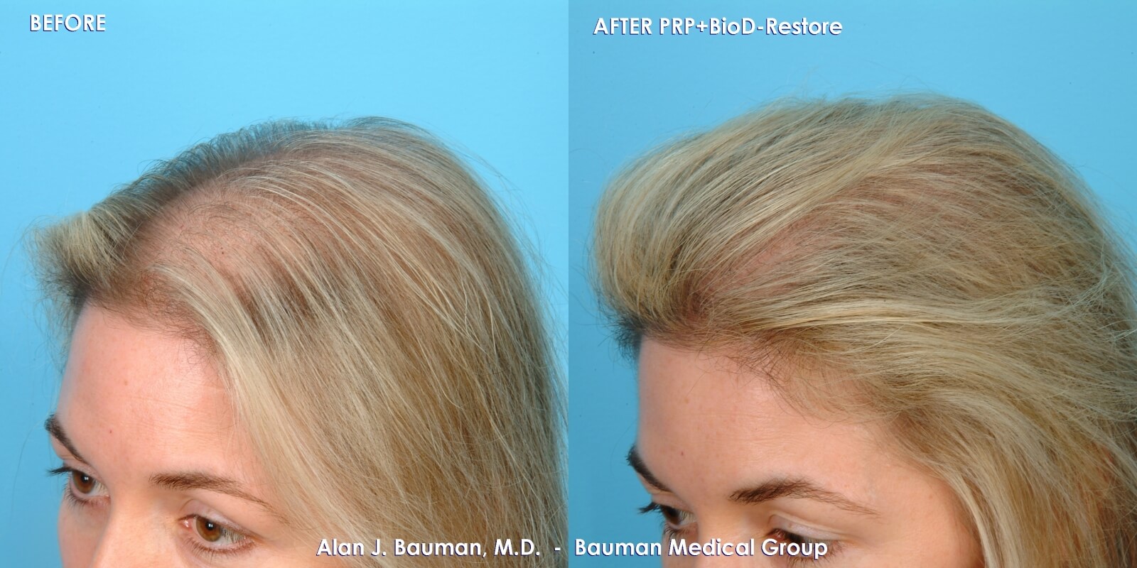 38 y/o Female PRP Hair Regrowth Treatment Results · Bauman Medical Group