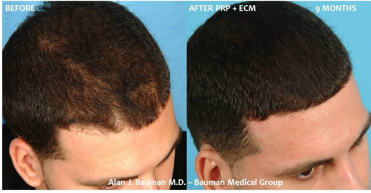 PRP-hair-regrowth-before-after-photo-36-