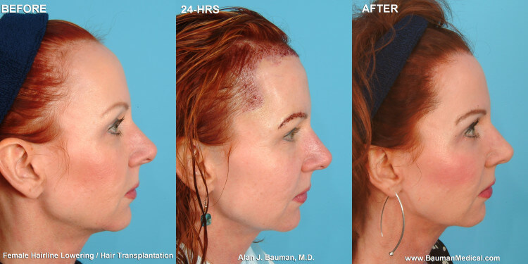 Female Hairline Lowering Hair Transplant Bauman Medical Group