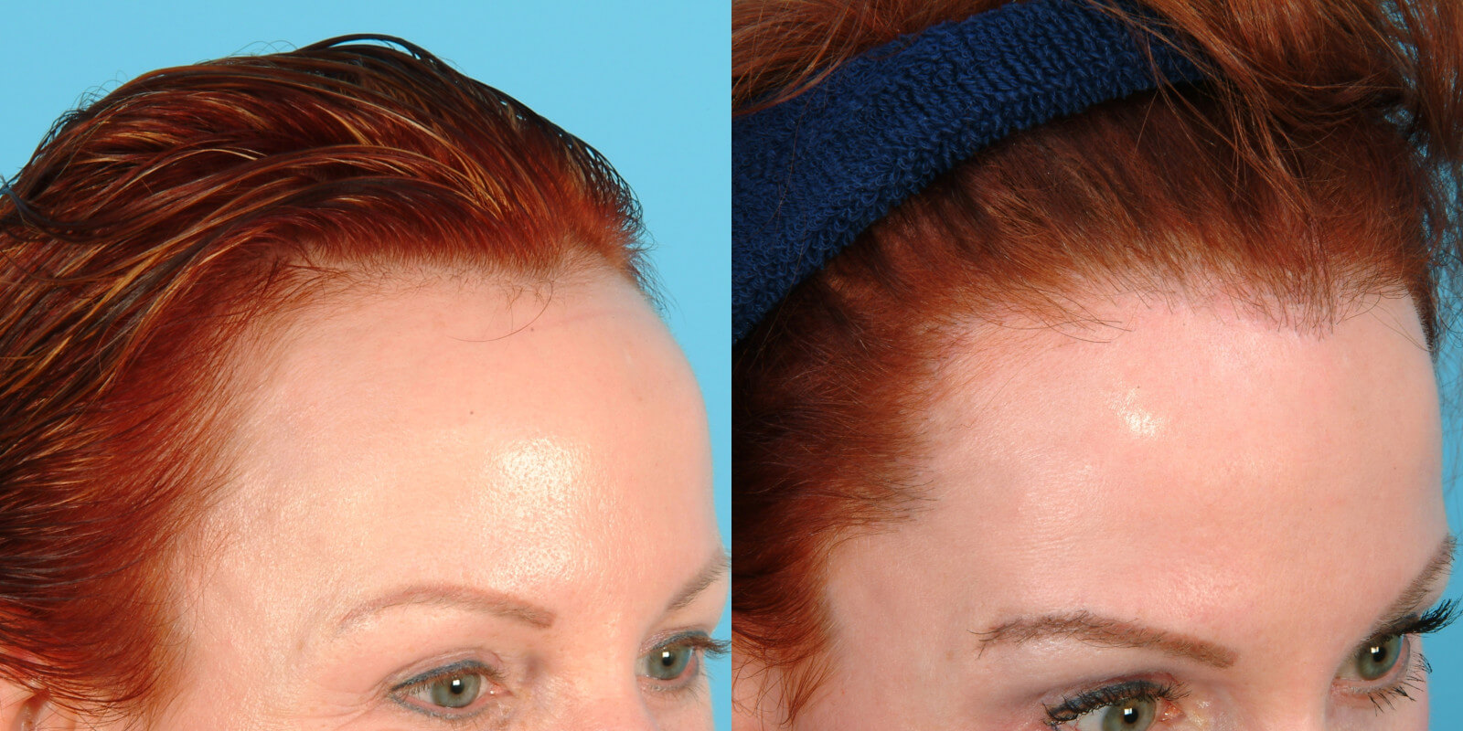 Female Hairline Lowering · Bauman Medical