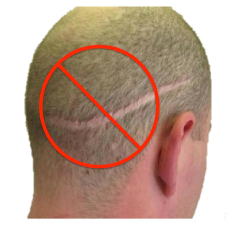 No Linear Scar Fue Hair Transplant