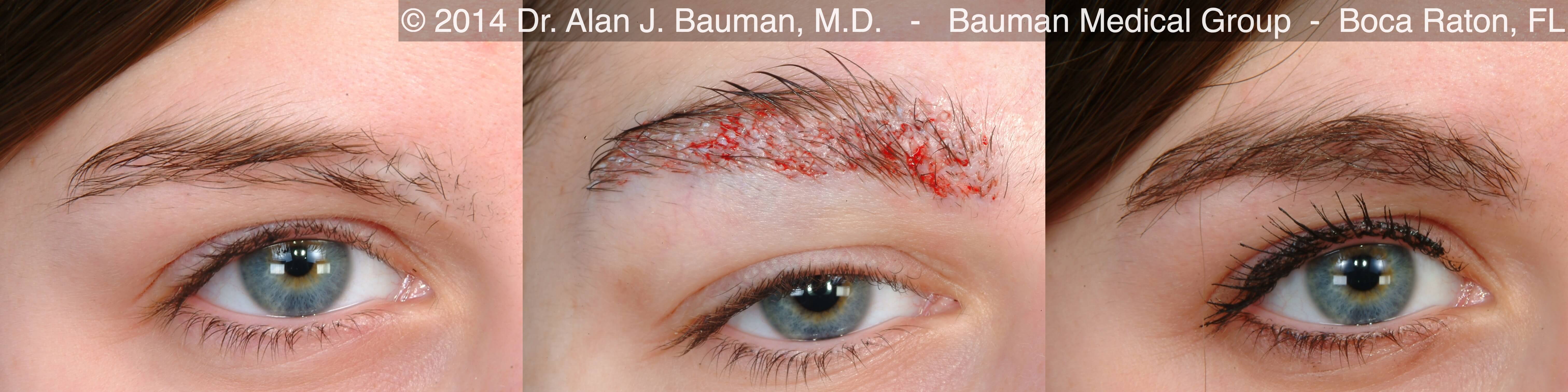 Eyebrow Transplantation Special Cases Bauman Medical Group