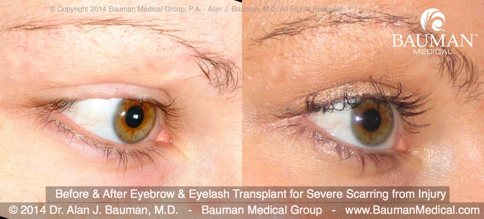 Eyelash Transplant and Implant Procedure