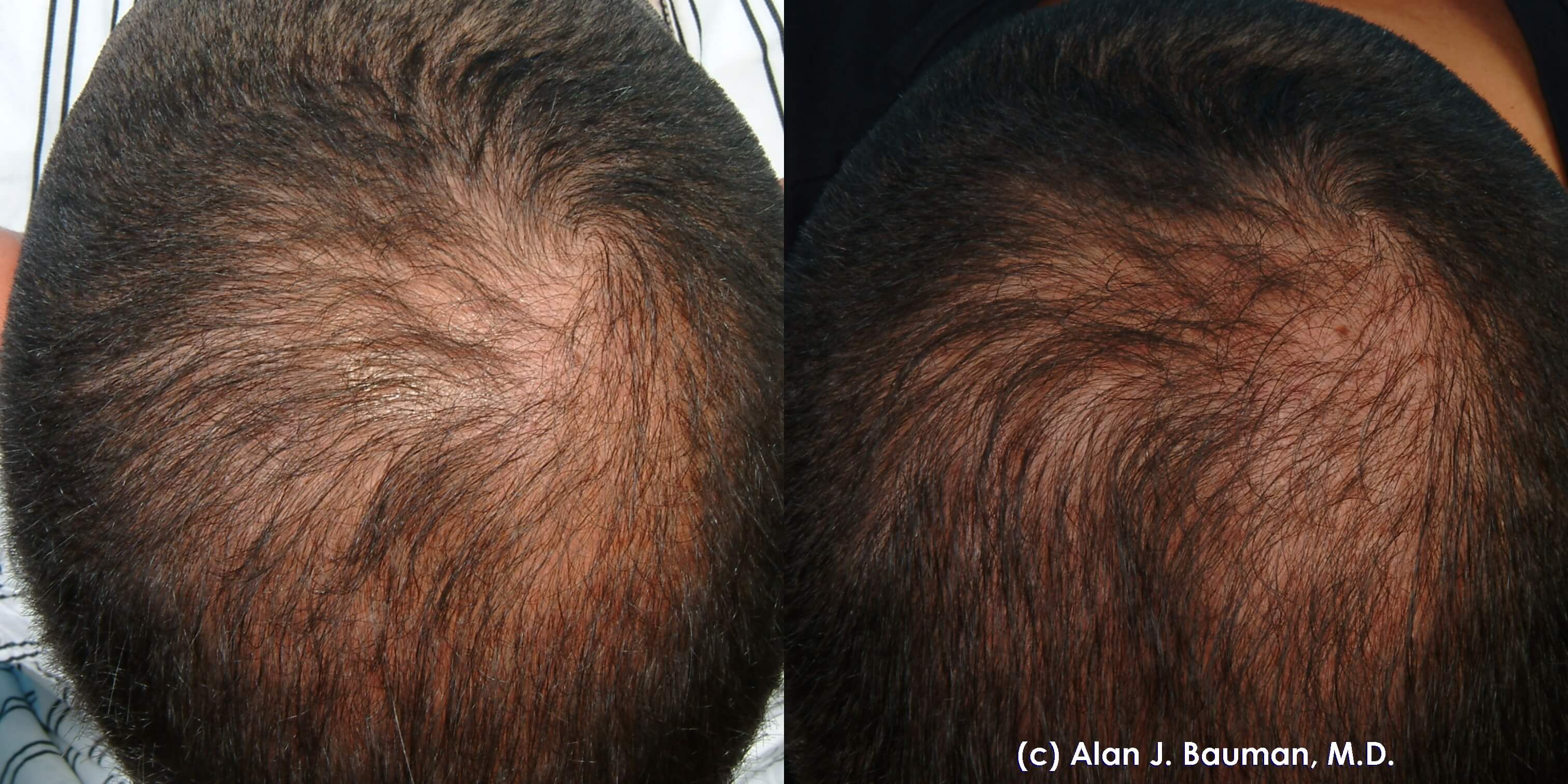 Prp Platelet Rich Plasma Acell Biod Ecms Bauman Medical Group throughout Prp For Hair Loss Cost