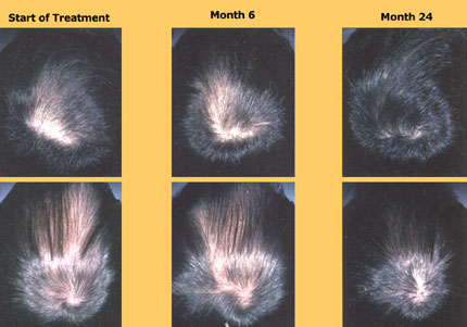 finasteride side effects after 3 months