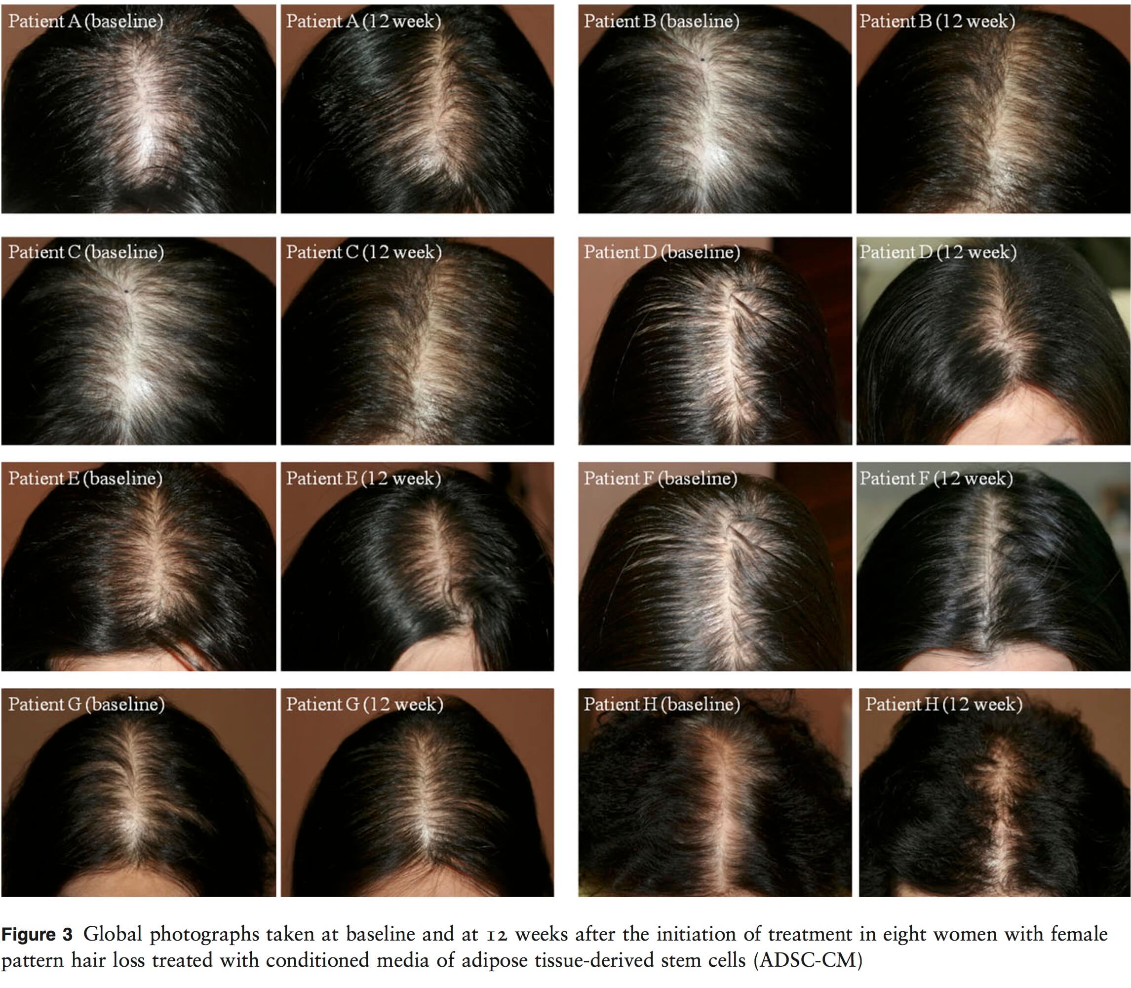 Advantages of Stem Cell Therapy for Hair Loss in India  Tour2India4Health  Blog