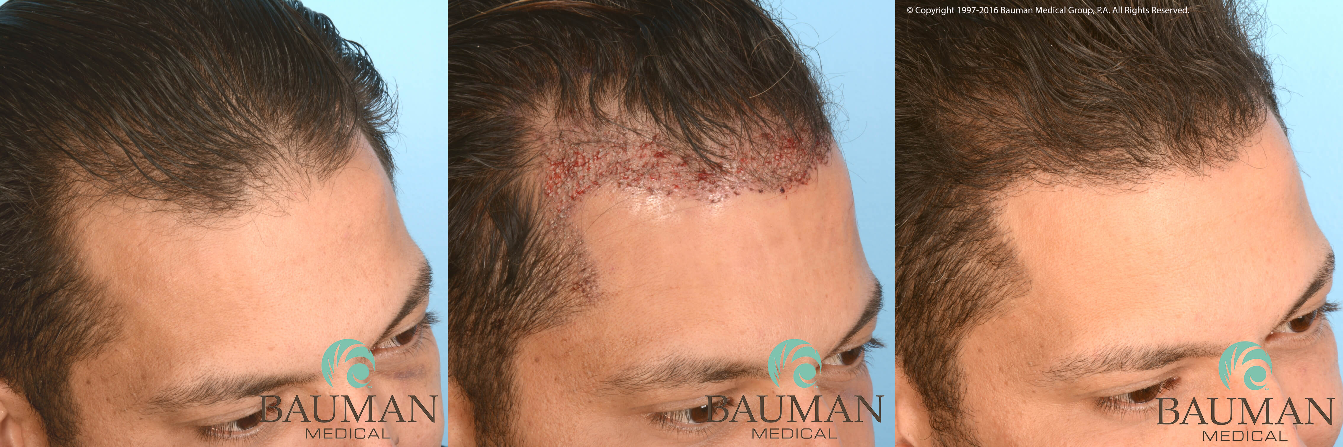 ARTICLE An Undetectable Hair Transplant Bauman Medical