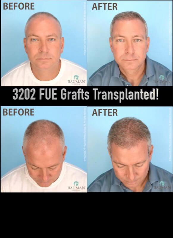 Reviews Archives Bauman Medical Video Patient Darrin S Review Of Artas Fue Hair Transplant With Dr Alan Bauman