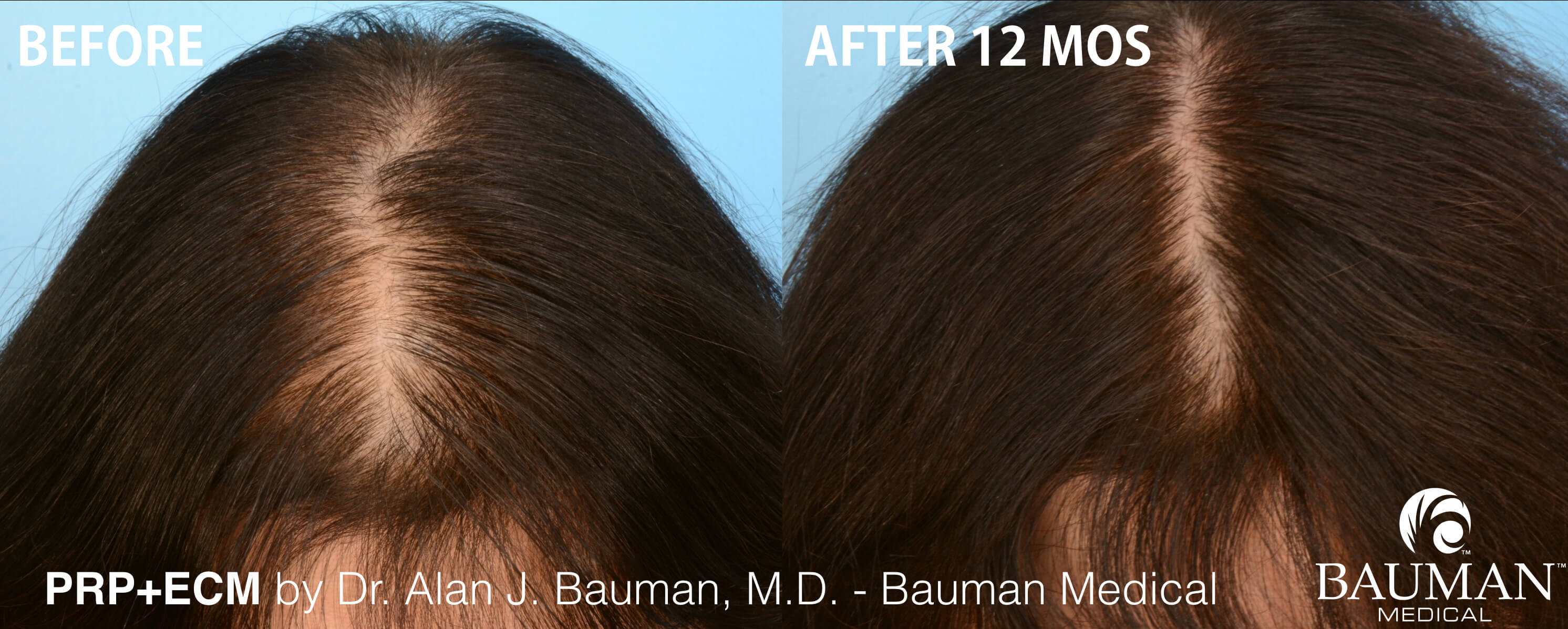 Prp Hair Regrowth Results In Female Patient · Bauman Medical