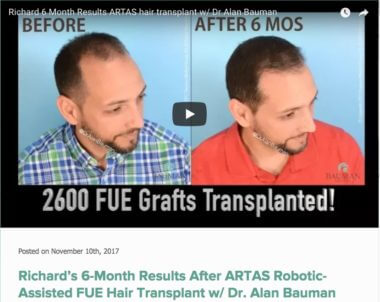 Reviews Archives Bauman Medical Artas Robotic Fue Hair Transplant Richard 6 Month Results